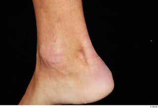 Claudio foot scar 0001.jpg